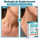 Adesivos Hiskin® Original - Removedor Invisível de Verrugas e Sinais na Pele |COMPRE 1 LEVE 3|